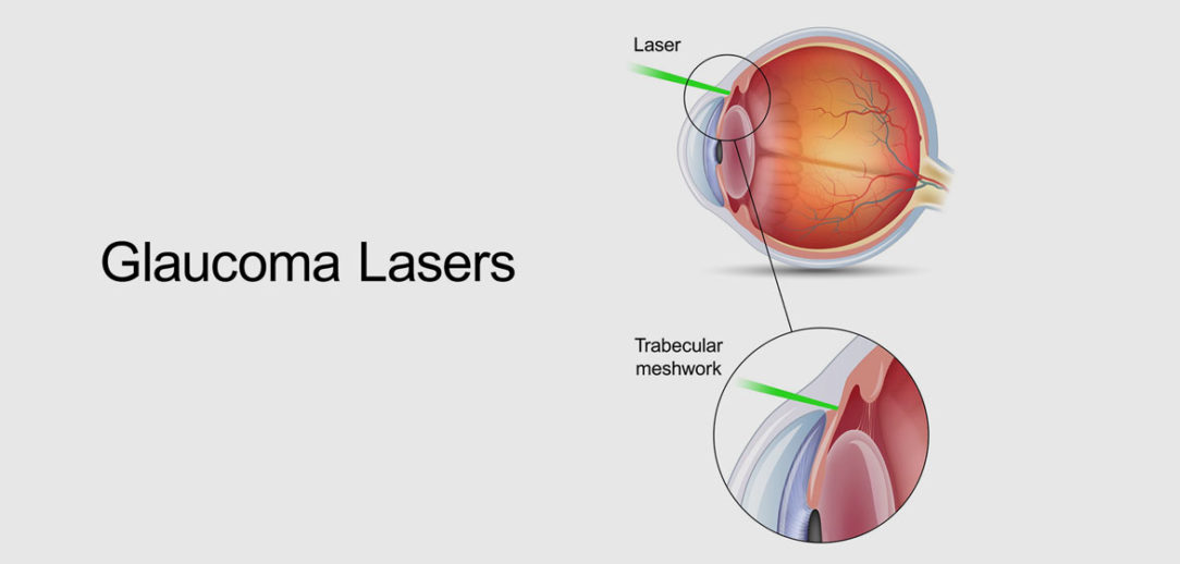  Trabeculoplasty Relieves Ocular Pressure to Treat Glaucoma